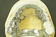 上下顎残存歯1次固定 下顎舌側エプロン リーゲルテレスコープ