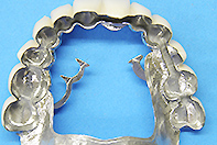 上顎全支台歯1次固定 リーゲルテレスコープ