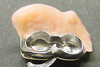 顎堤吸収対応インプラントリーゲル