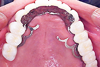 上顎天然歯＋片側インプラントリーゲルテレスコープ