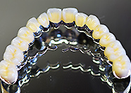 インプラント　天然歯+インプランリーゲル可撤式上部構造（BMK)